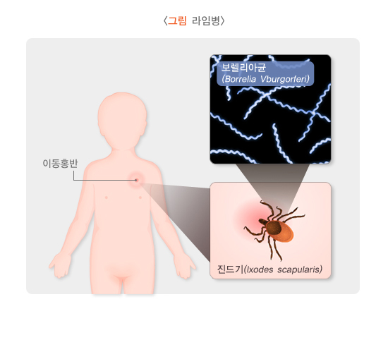 라임병