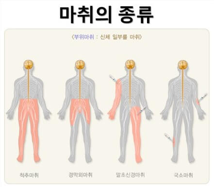 마취의 종류
