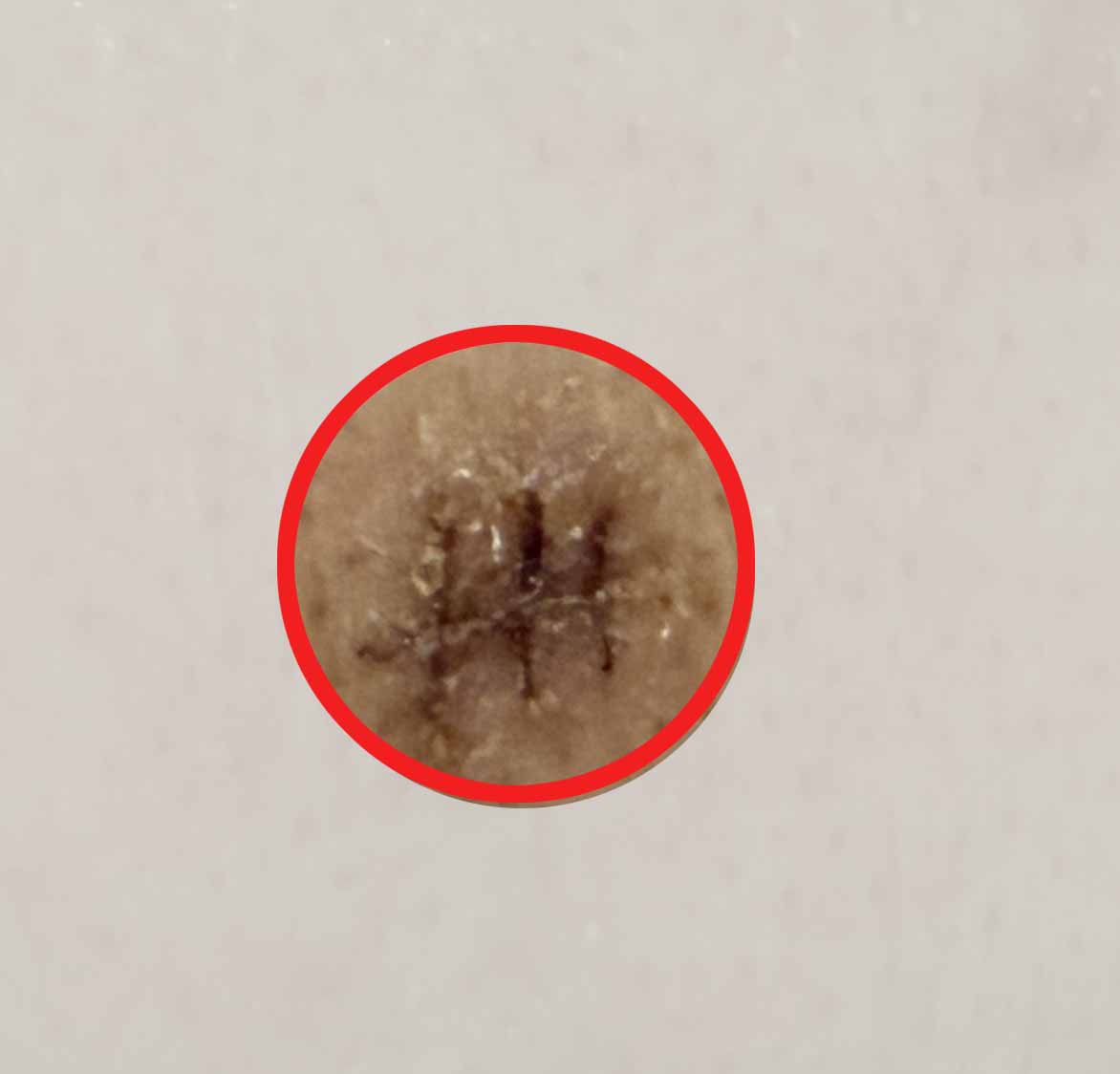 피지낭종제거-수술부위-등