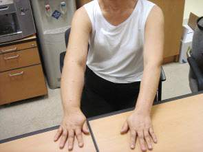 몸이 붓는 원인