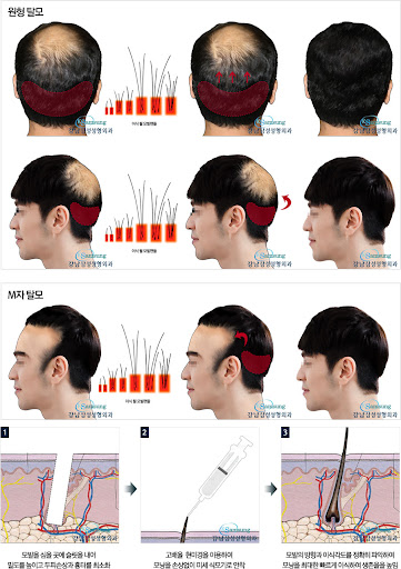 모발이식-방법