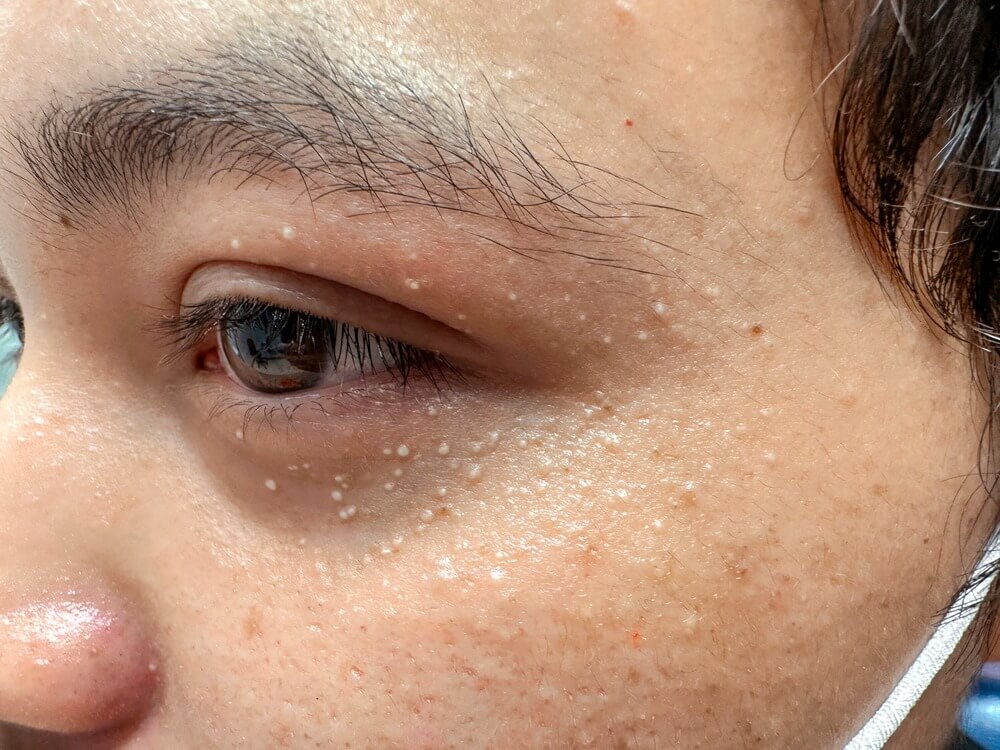 눈가 비립종 발생 원인과 피부과 제거 시술 과정을 설명하는 피부 관리 정보 이미지로 각질 낭종의 구조와 올바른 관리 방법을 안내하는 스킨케어 가이드 자료
