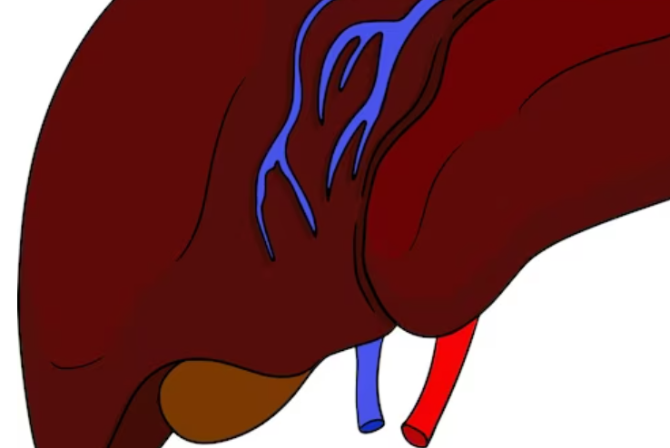 담도 폐색의 원인 염증