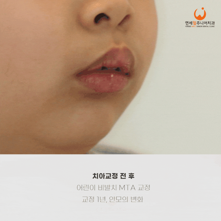 턱끝이 뒤로 들어가 무턱처럼 보이는 초등학생 사선 측면