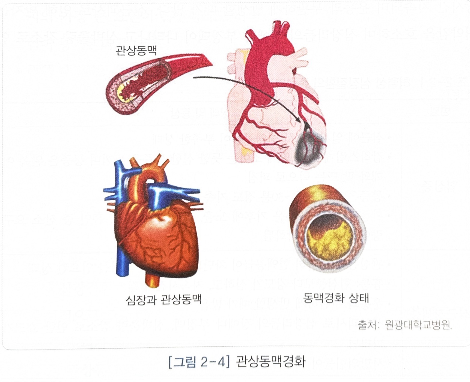 허혈성 심장질환