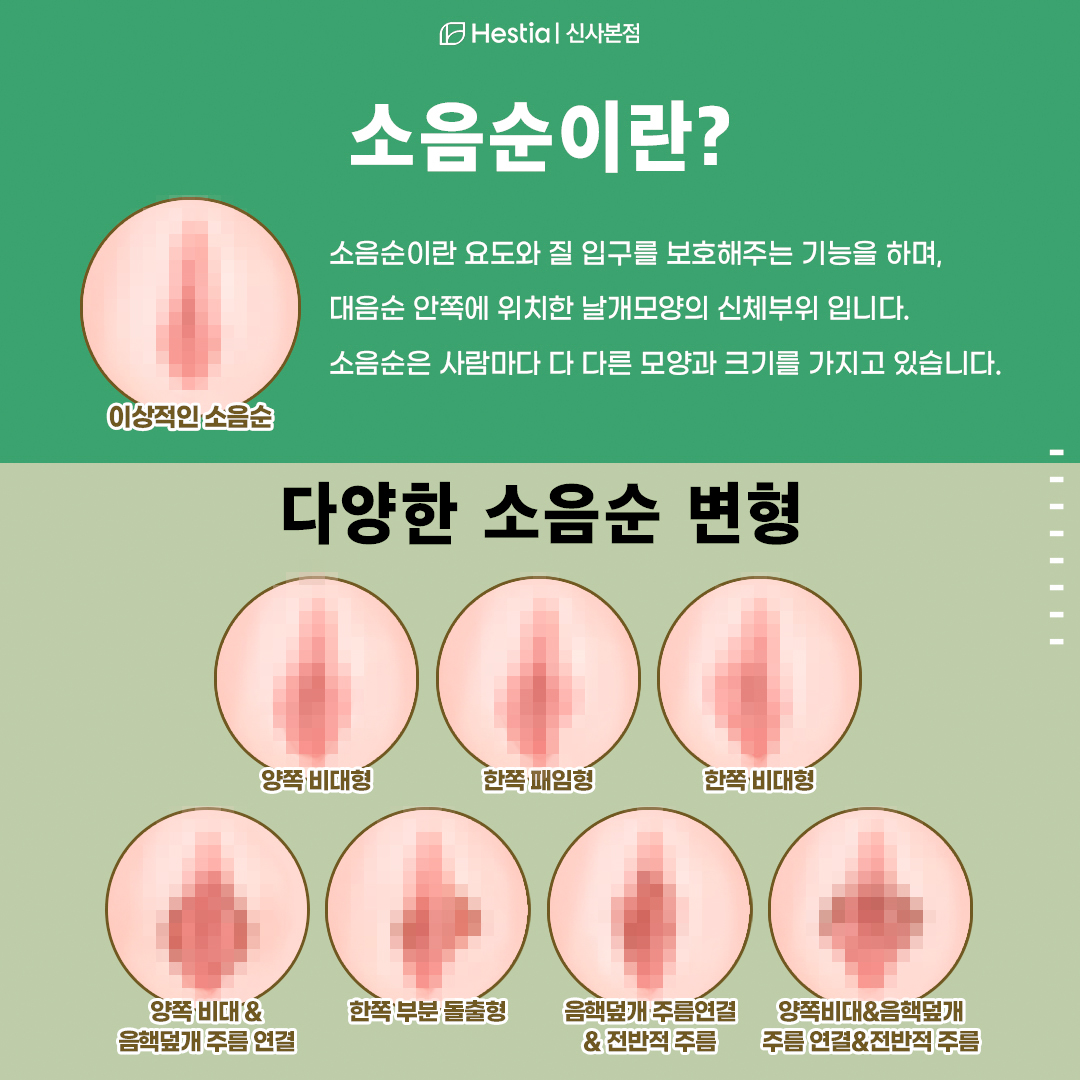 다양한 소음순의 모양