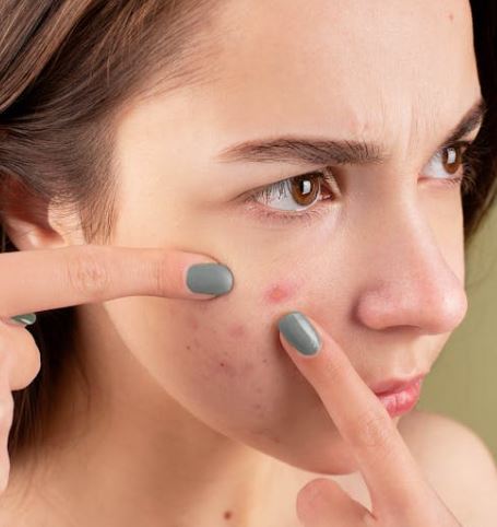 여드름 빨리 없애는 법 원인 증상