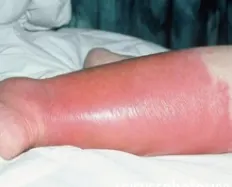 봉와직염으로 붓고 빨개진 다리