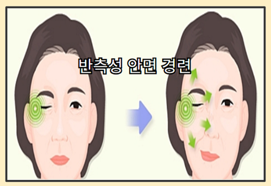눈꺼풀 또는 눈밑이 떨리는 이유 - 특정 반측성 안면 경련 질환