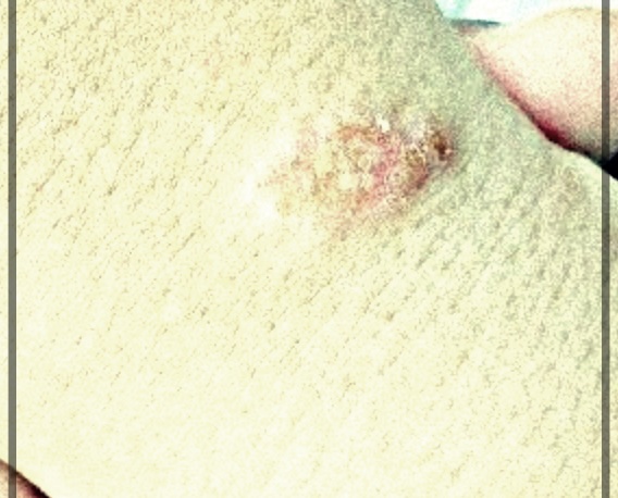 성인 농가진: 원인, 증상, 및 치료 방법