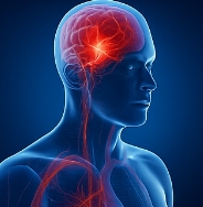 뇌출혈 전조증상