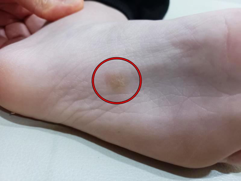 굳은살 냉동치료 전