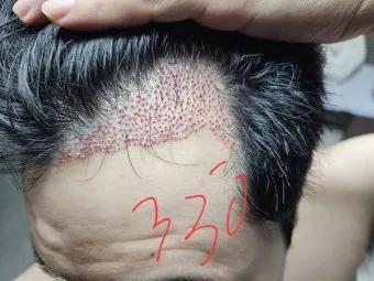 머리카락 이식 3000모 3000모낭 비용과 시술 과정_5