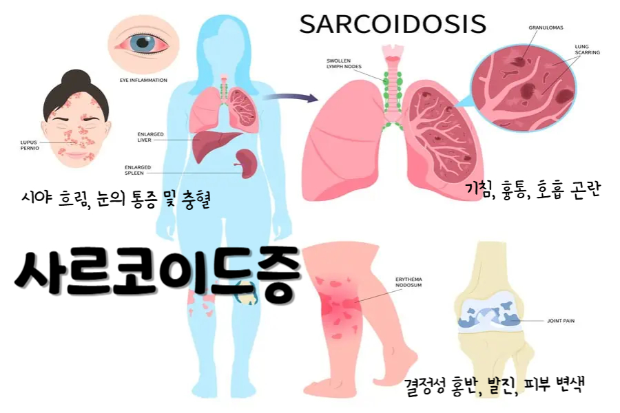 사르코이드증
사르코이드증의 증상 : 시야 흐림, 눈의 통증 및 출혈, 기침, 흉통, 호흡 곤란, 결정성 홍반, 발진, 피부 변색