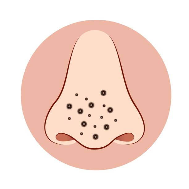 소극성속모증 원인