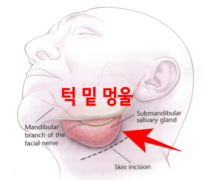 턱-밑-멍울