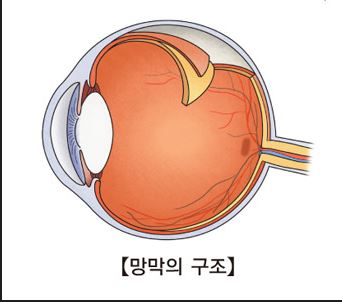 망막 박리 증상