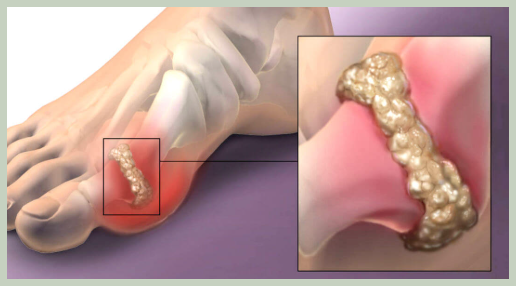 요산수치가 높을때 예방법