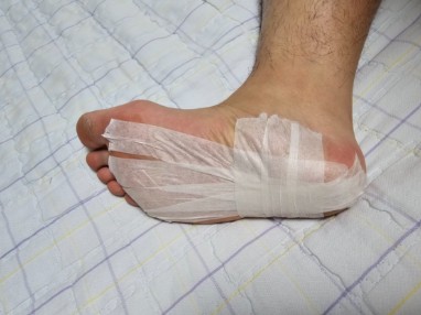 발 통증으로 치료 받은 후 모습