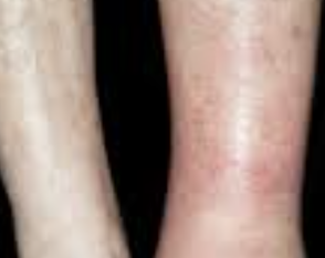 백혈병 초기증상 27