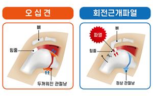 어깨가 아파요