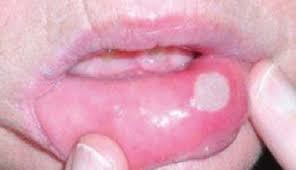 입안이 자주 허는 이유