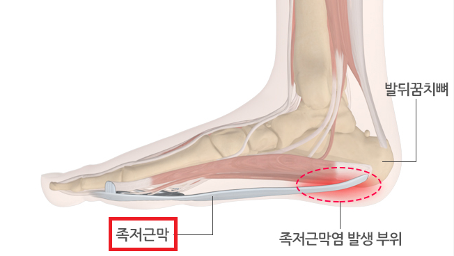 족저 근막