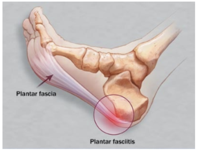 족저근막염(3)