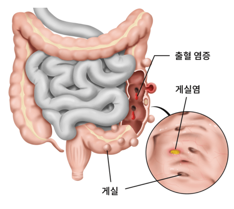 게실염
