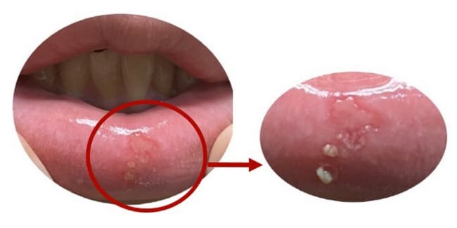 구내염에꿀바르기
