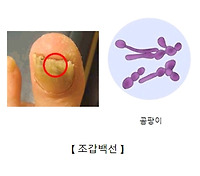 발톱무좀약