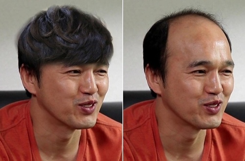 김광규-탈모-이미지-비포애프터