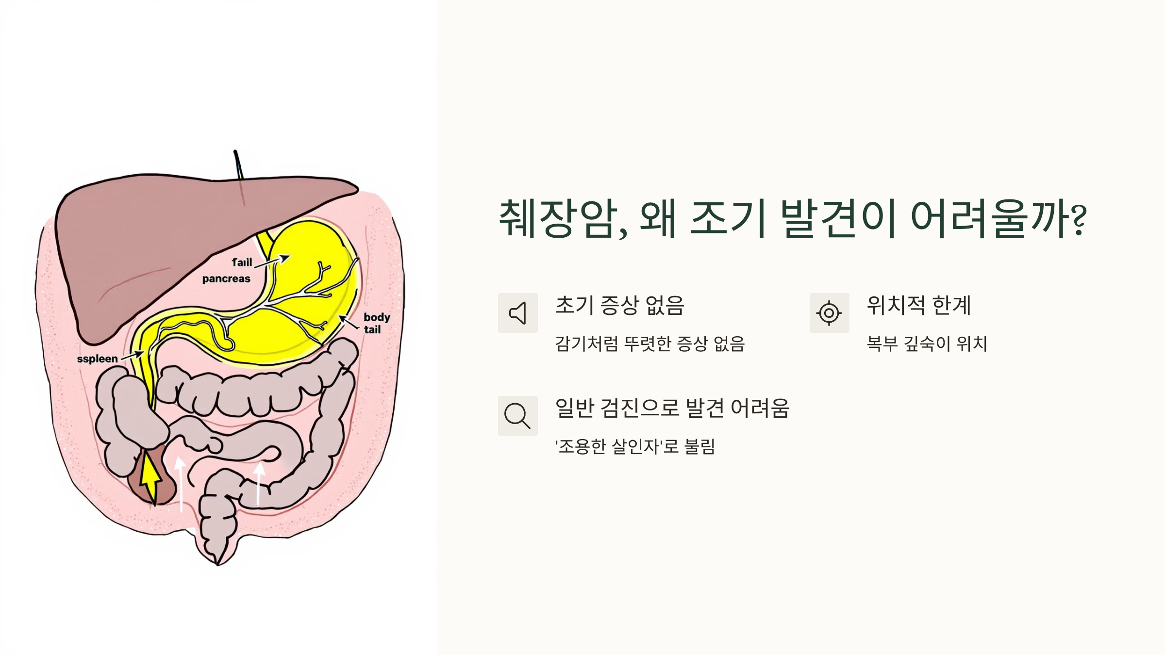 췌장암, 왜 조기 발견이 어려울까?