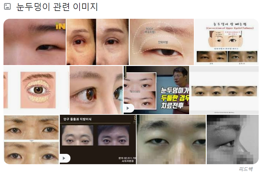 눈두덩이 사진이 모아진 사진이다.