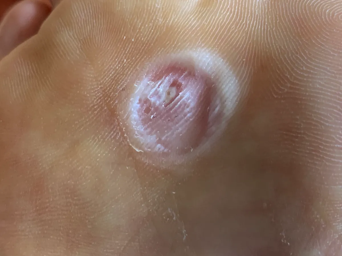 티눈-굳은살-제거후-발바닥