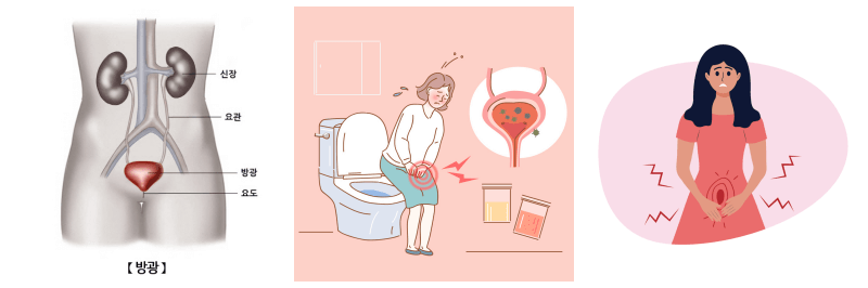 방광염, 복통 사진