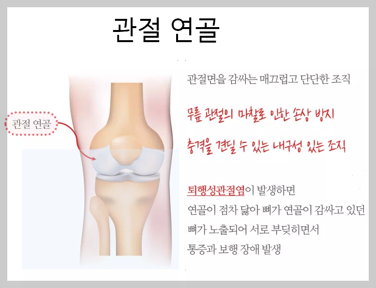 연골 관절