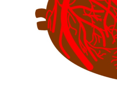 관상동맥 석회화 증상