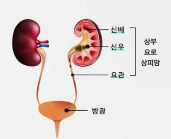 전이성 요로상피암 원인과 치료법