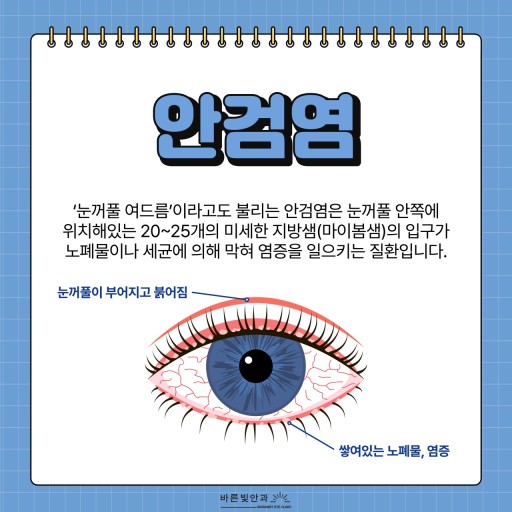 안검염 관련 이미지