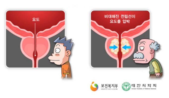 전립선 비대증