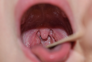 편도선이 하얗고 아픈 이유