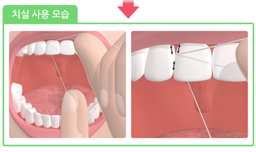 입냄새 원인, 입냄새 제거, 입냄새 확인 및 입냄새 관리 치료방법 안내