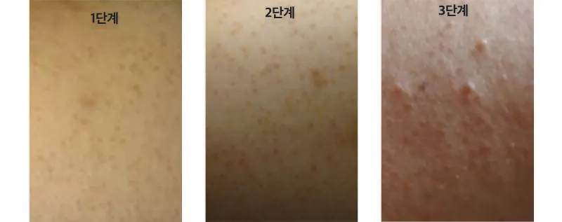 모공각화증 단계