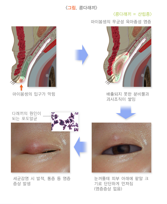 콩다래끼 관련 이미지