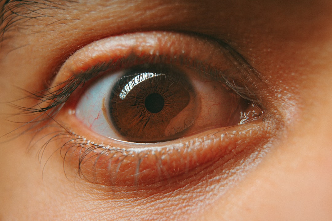 Cataract