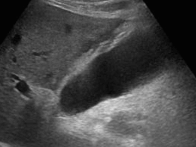 무결석 담낭염 (Acalculous cholecystitis )