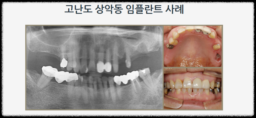 임플란트 시술