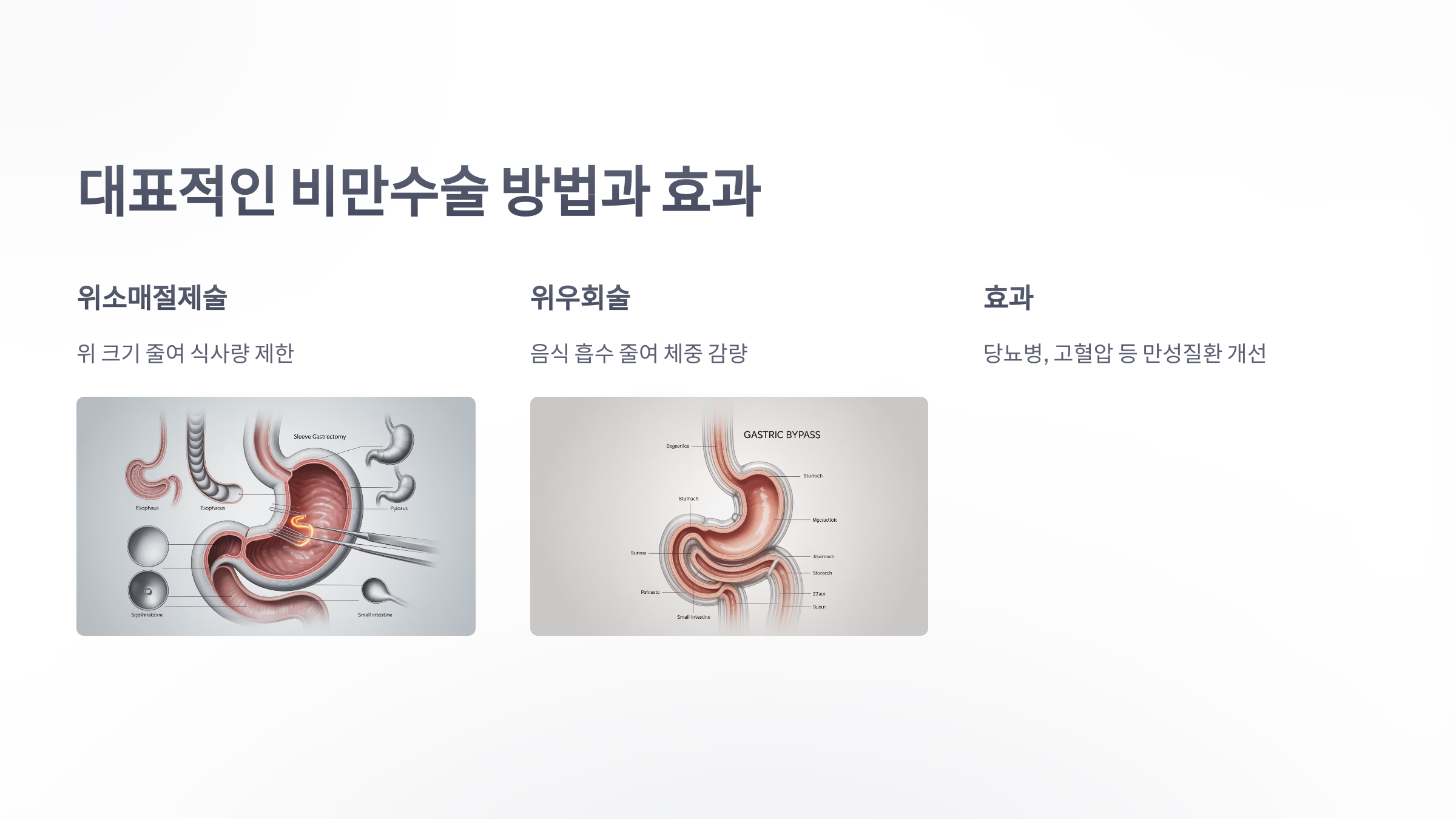 참조-비만수술-효과,-성공사례-3