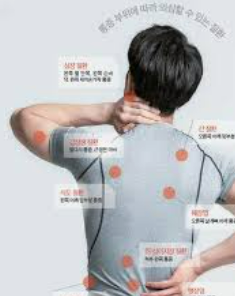 근막통증증후군